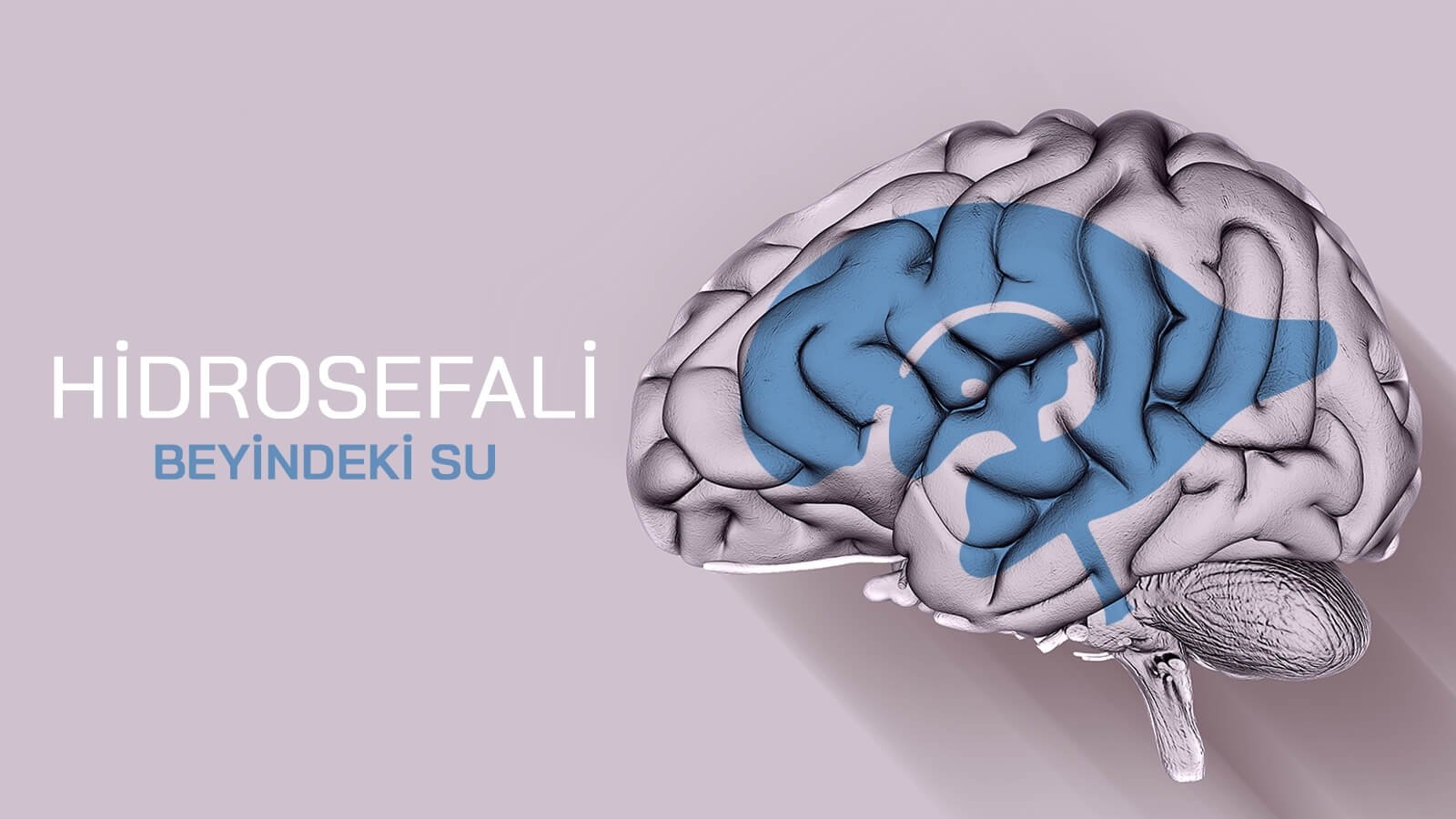 Hidrosefali (Beyindeki Su)